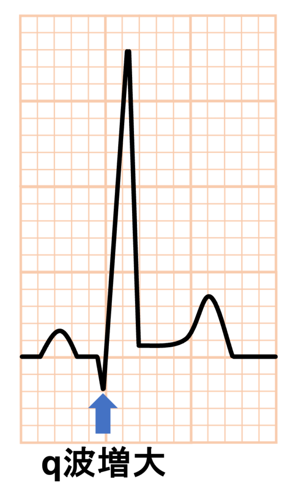 左室容量負荷(left ventricular volume overload)