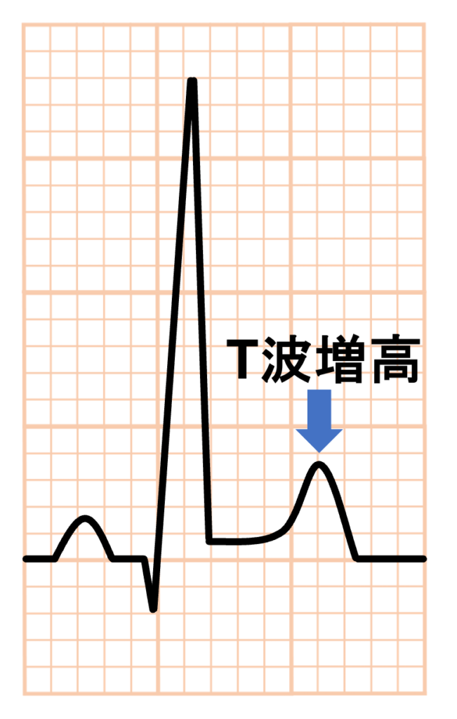 左室容量負荷(left ventricular volume overload)