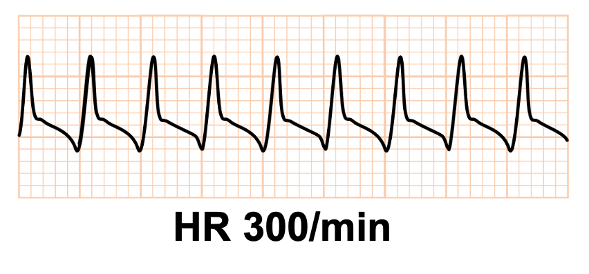 1:1心房粗動(1:1 atrial flutter)