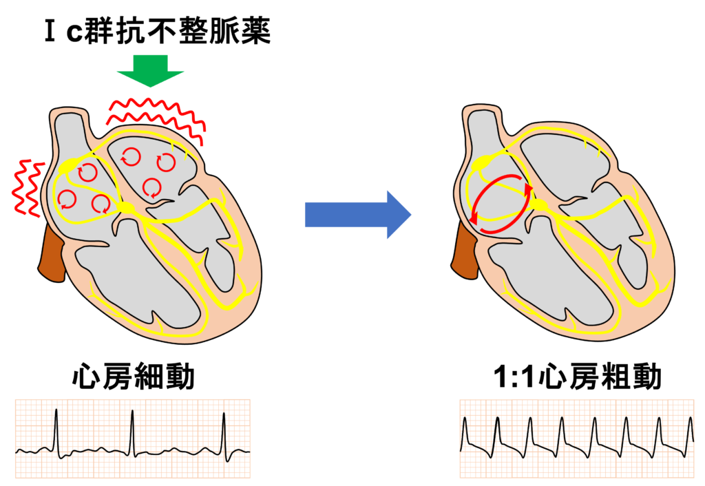 1:1心房粗動(1:1 atrial flutter)