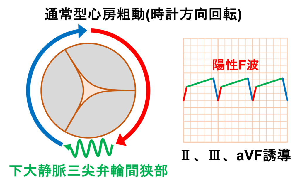 心房粗動(Atrial flutter)