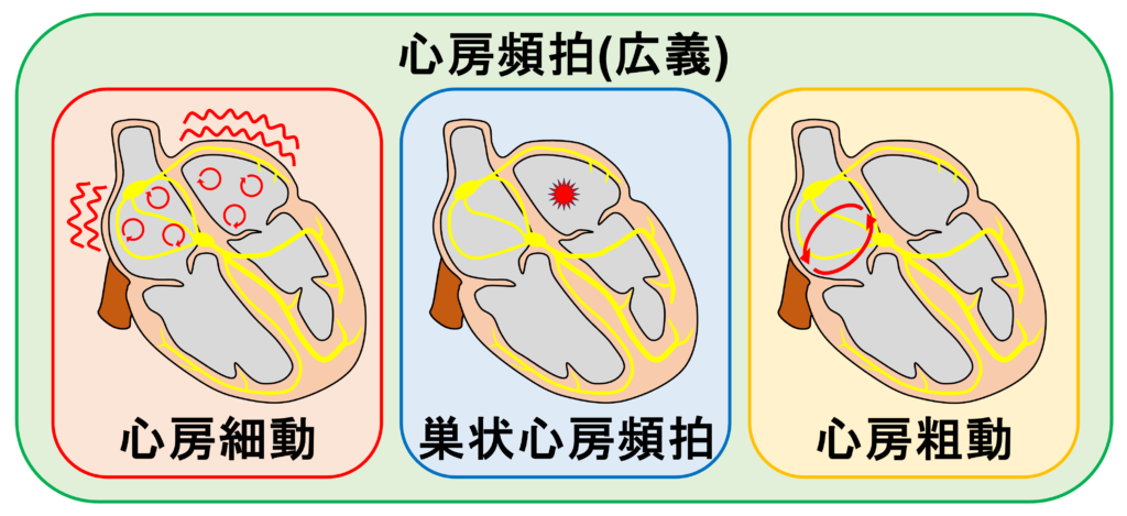 心房頻拍(atrial tachycardia)