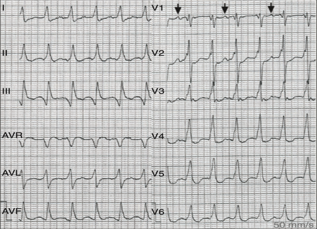 心室二重応答(double ventricular response)