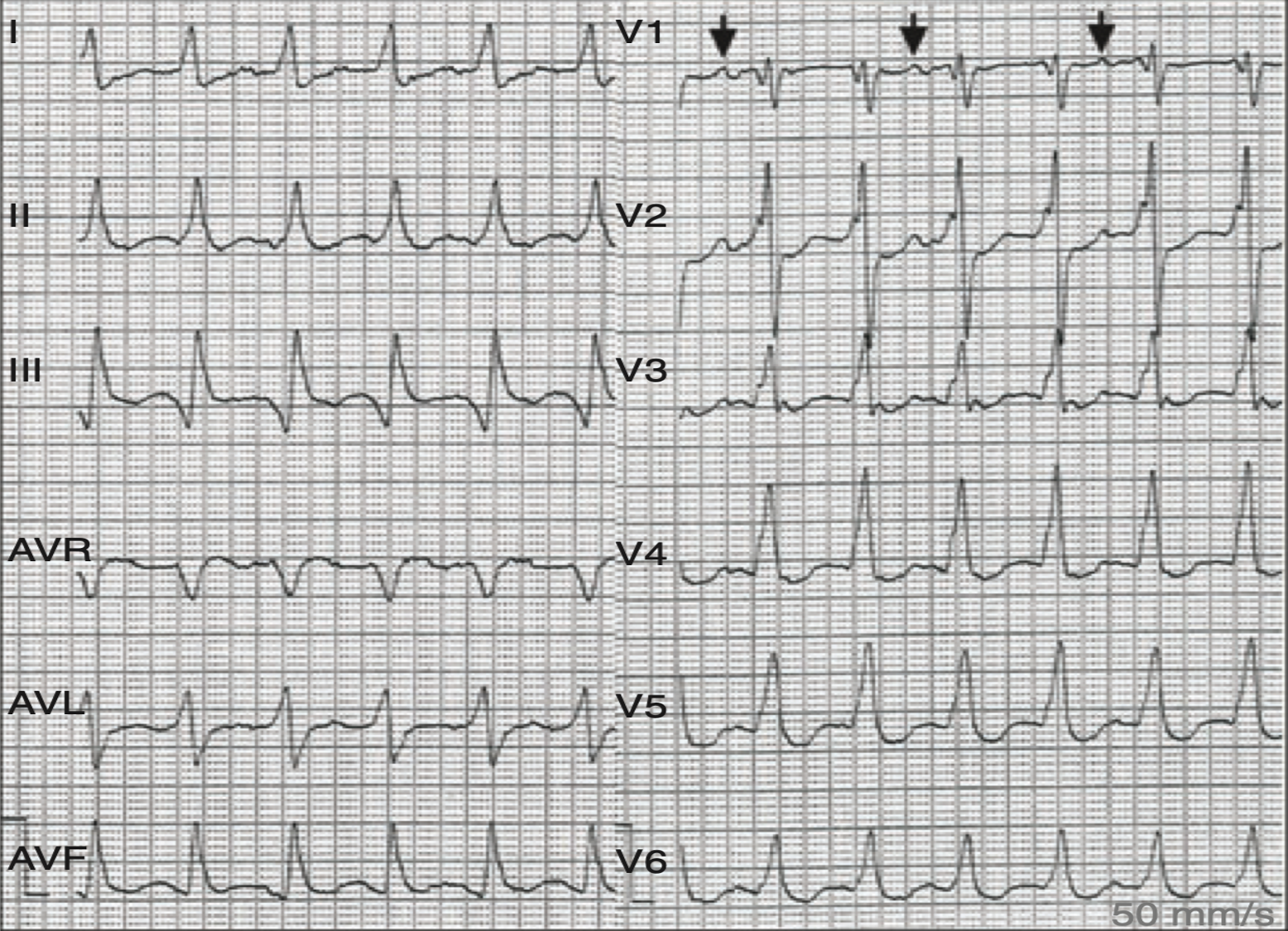 心室二重応答(double ventricular response)