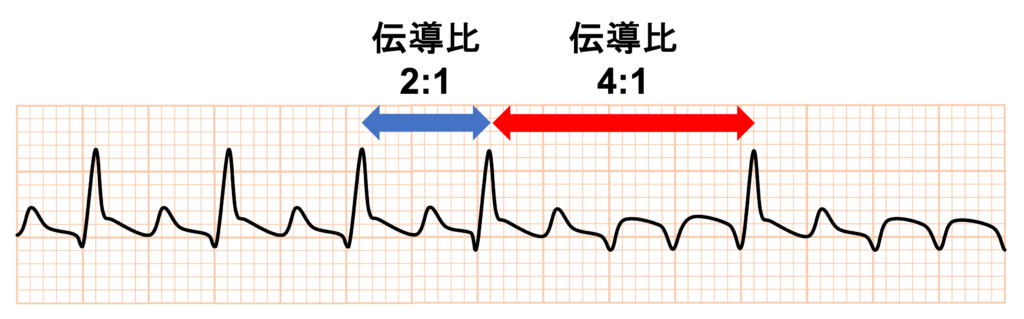 心房粗動(Atrial flutter)