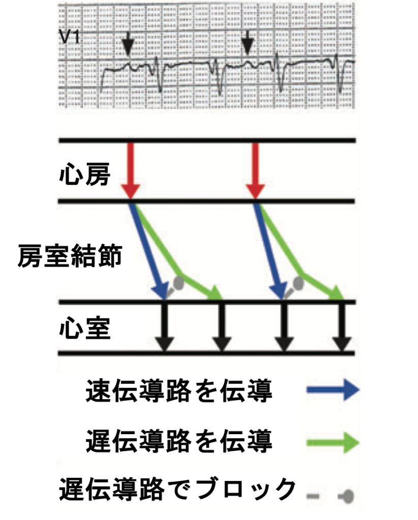 心室二重応答(double ventricular response)