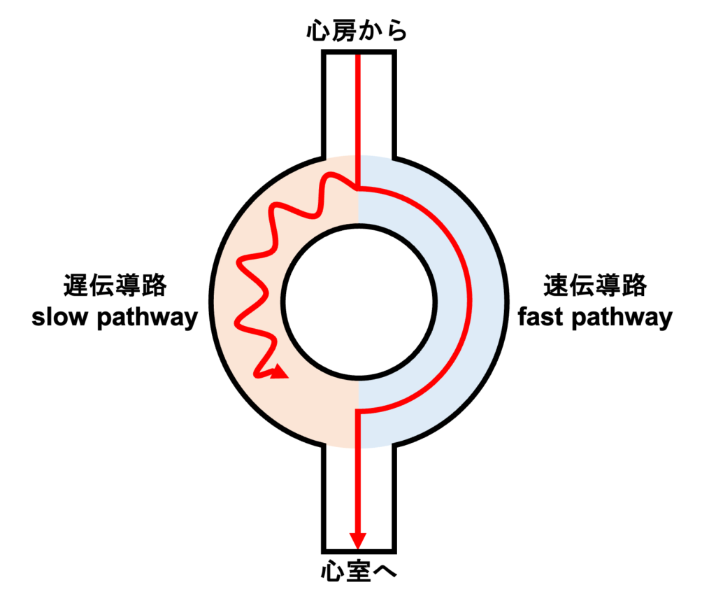 心室二重応答(double ventricular response)