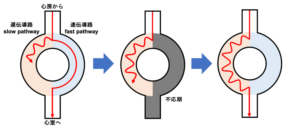 心室二重応答(double ventricular response)