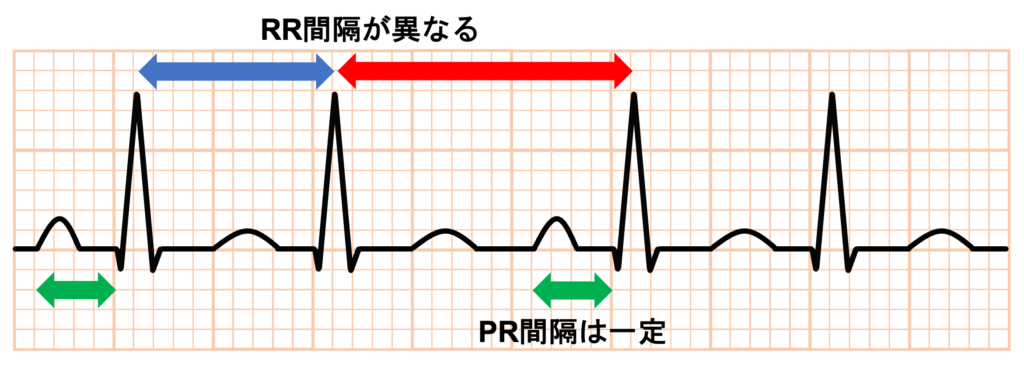 心室二重応答(double ventricular response)