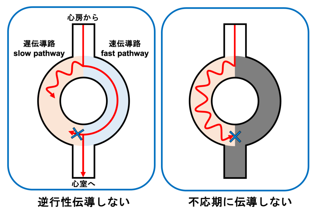 心室二重応答(double ventricular response)