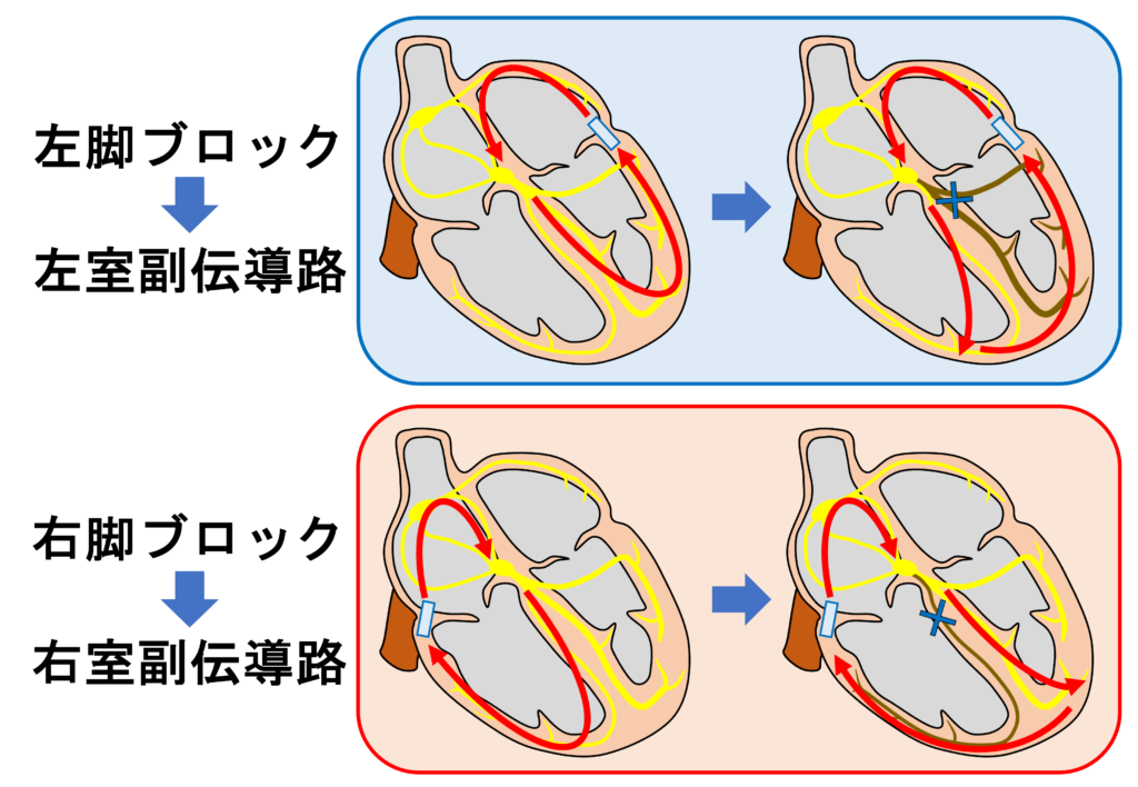 クーメル現象(coumel phenomenon)