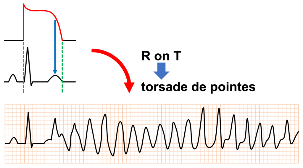 早期後脱分極(early afterdepolarization：EAD)