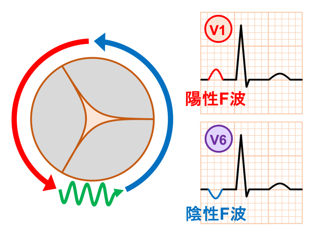 心房粗動(Atrial flutter)