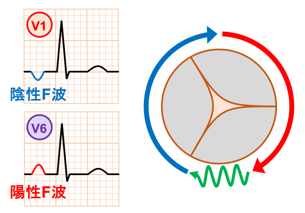 心房粗動(Atrial flutter)