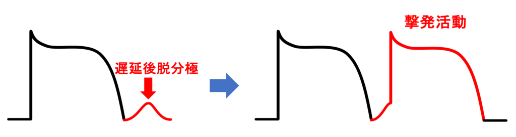 遅延後脱分極(delayed afterdepolarization：DAD)