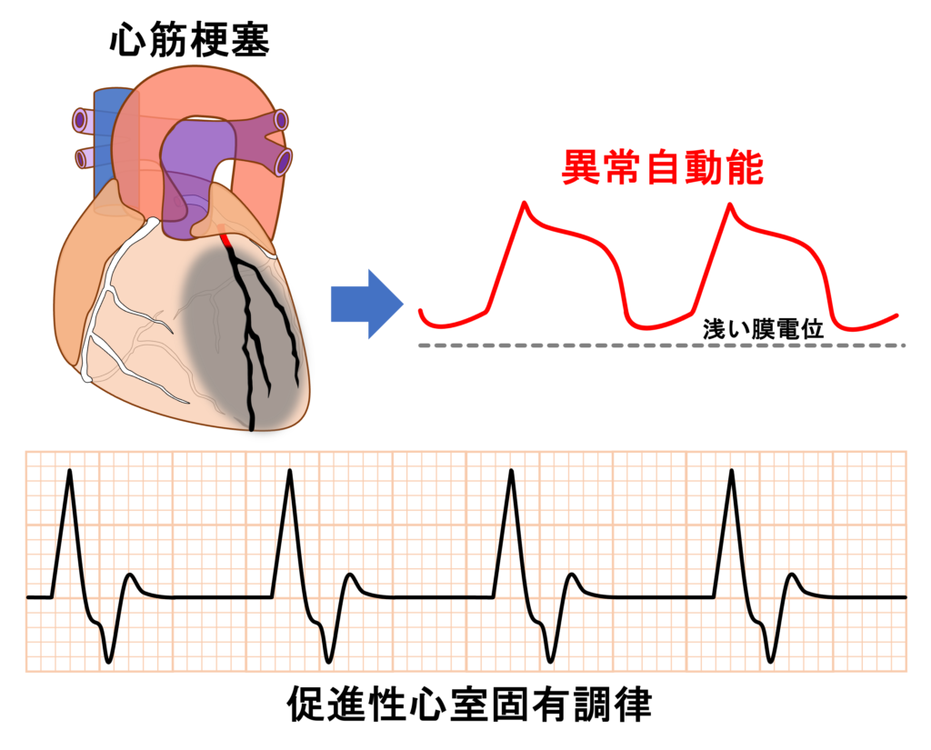 異常自動能(abnormal automaticity)