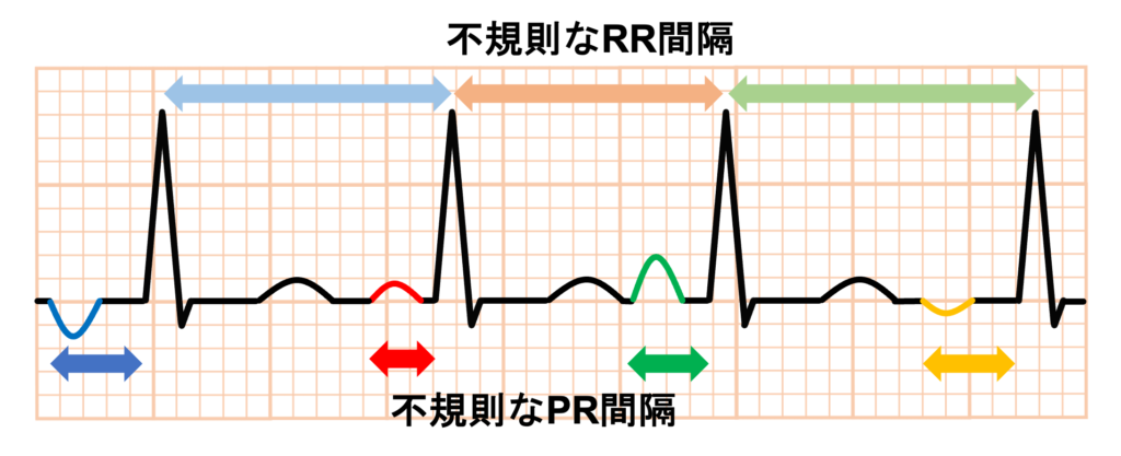 多源性心房頻拍（multifocal atrial tachycardia：MAT）