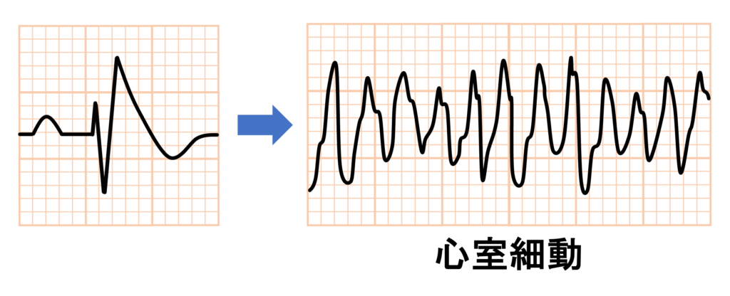 ブルガダ症候群(Brugada syndrome)