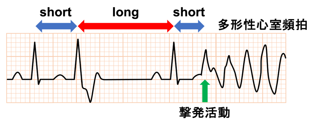 早期後脱分極(early afterdepolarization：EAD)