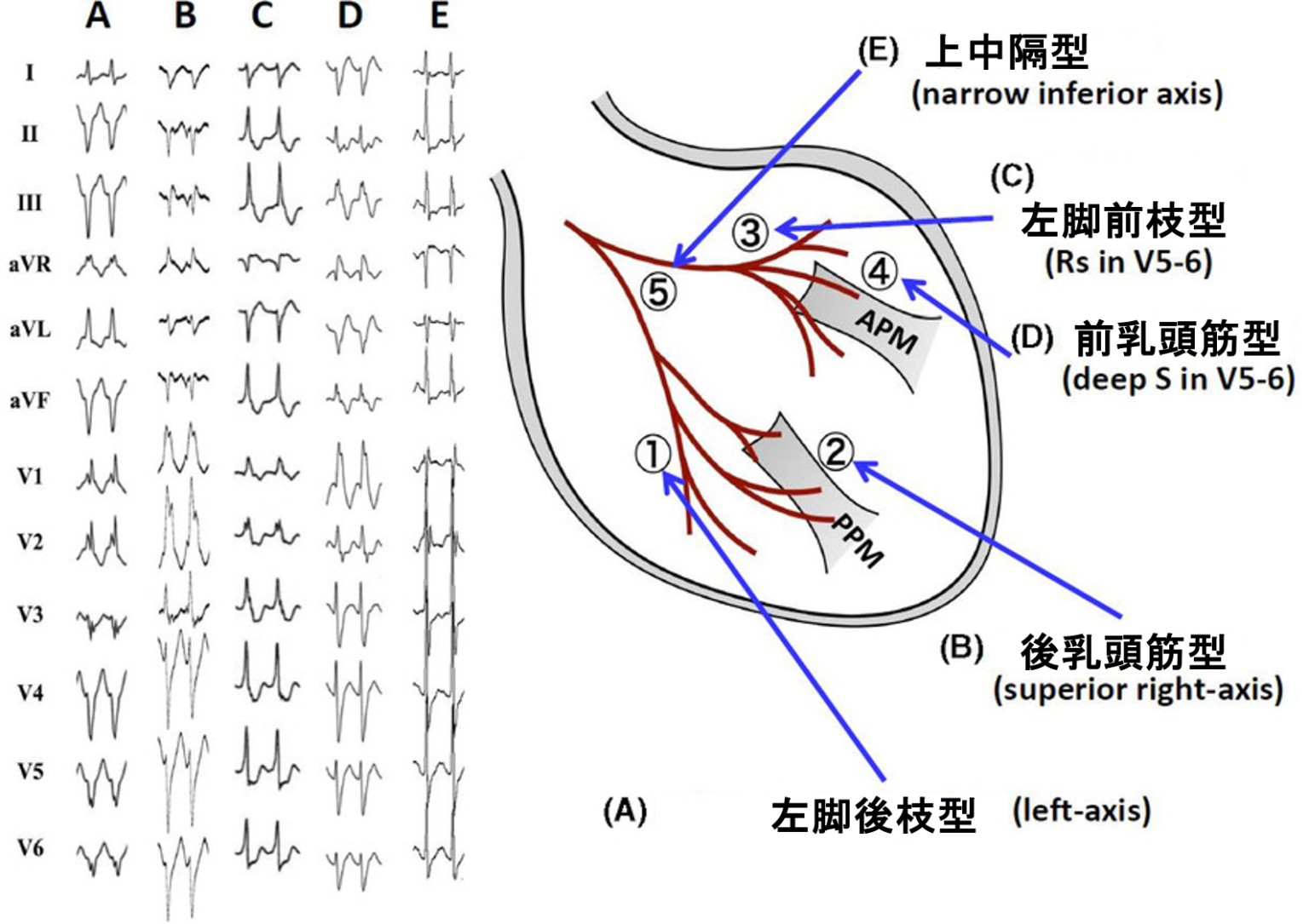 ベラパミル感受性心室頻拍とは？ | 心電図.com