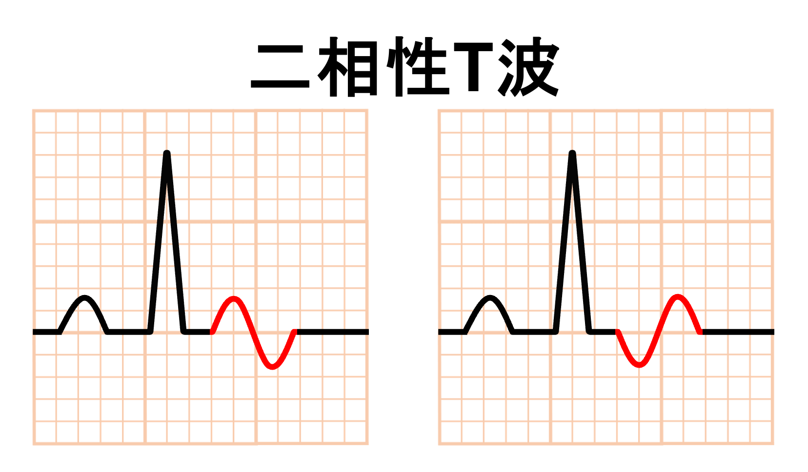 二相性T波とは? | 心電図.com