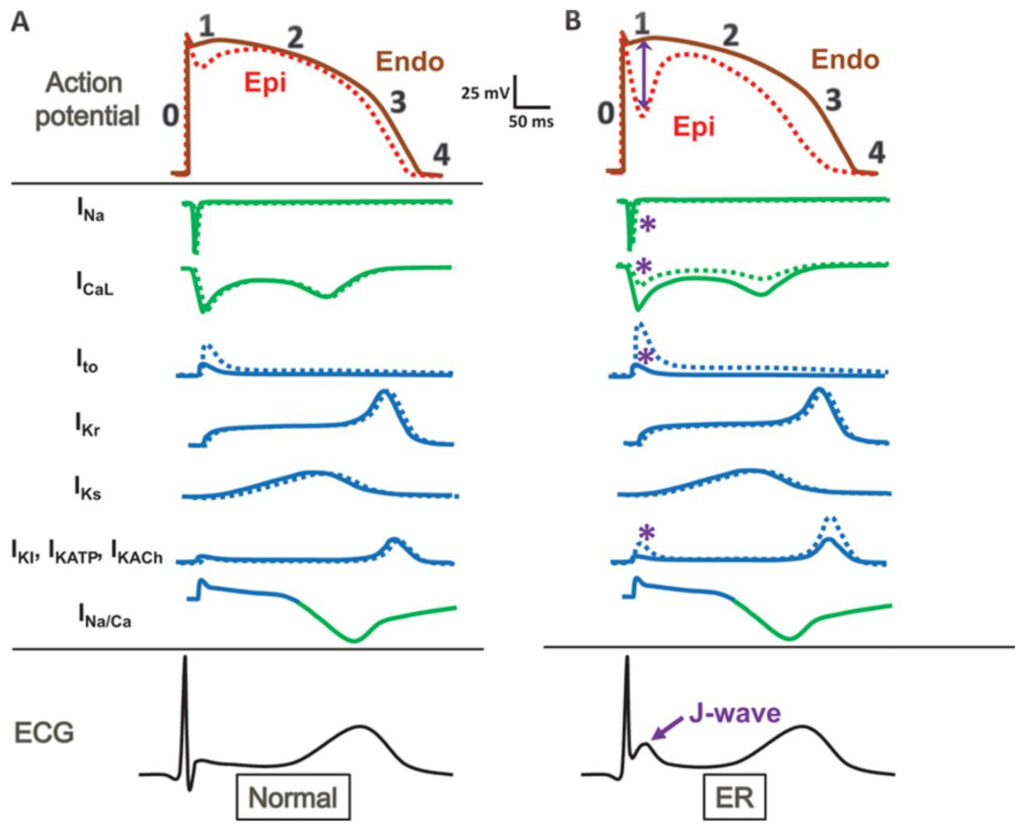 早期再分極症候群(early repolarization syndrome)