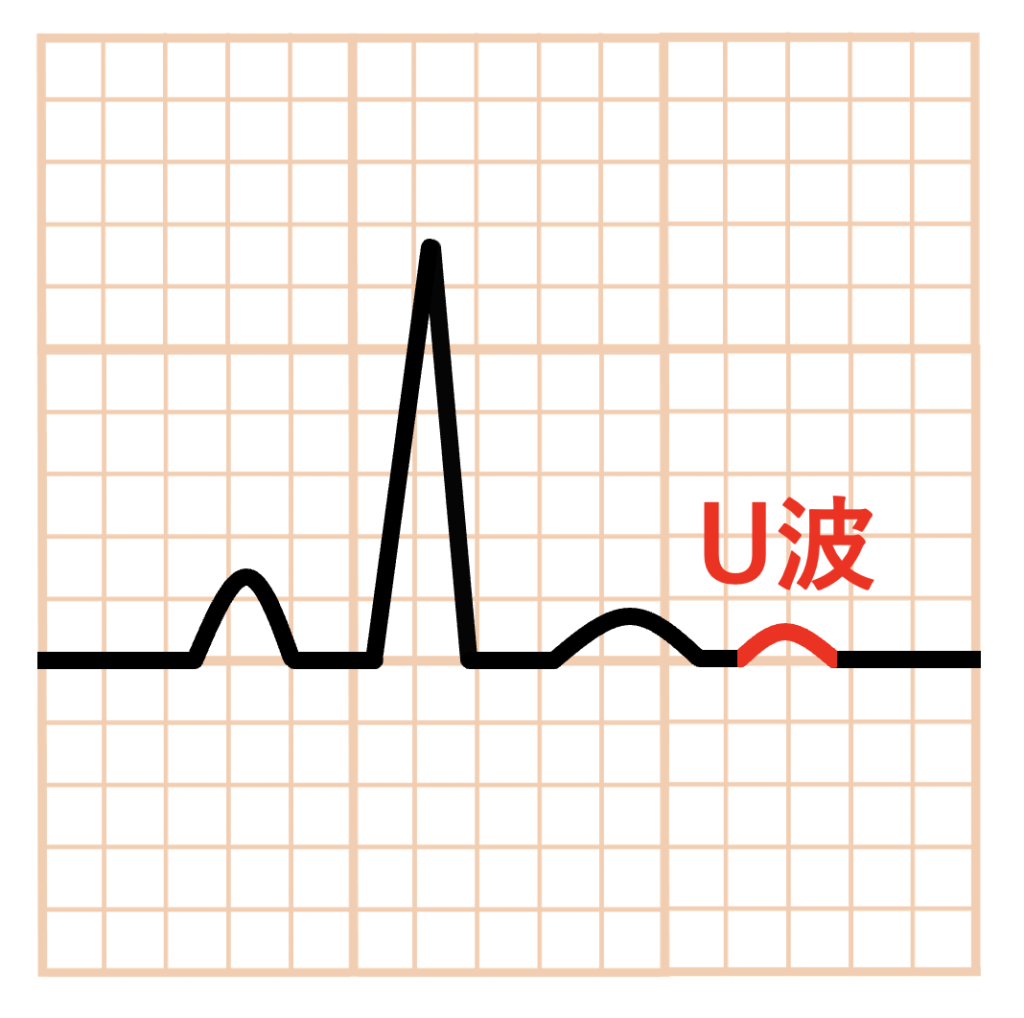 U波(U wave)