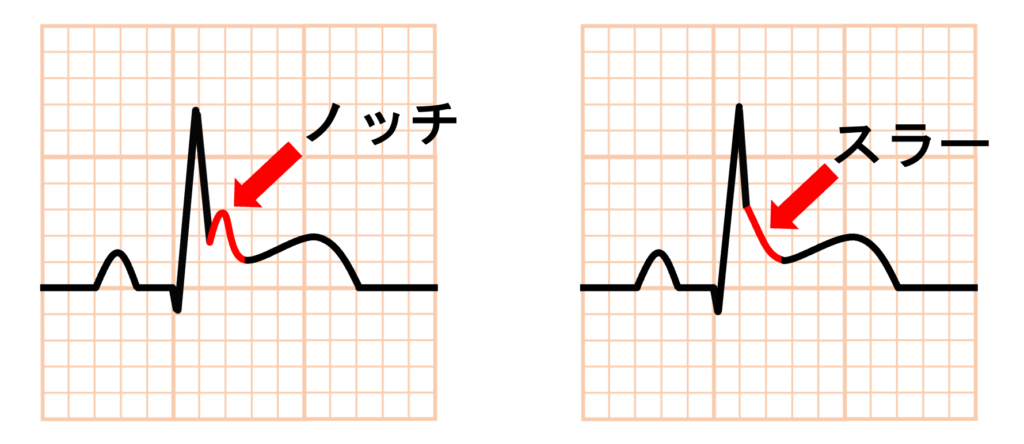 J波(J wave)