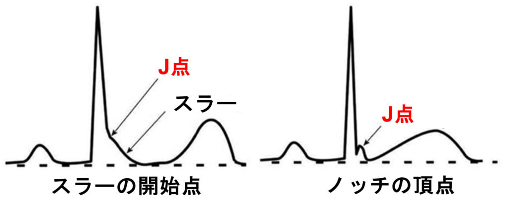 早期再分極(early repolarization)