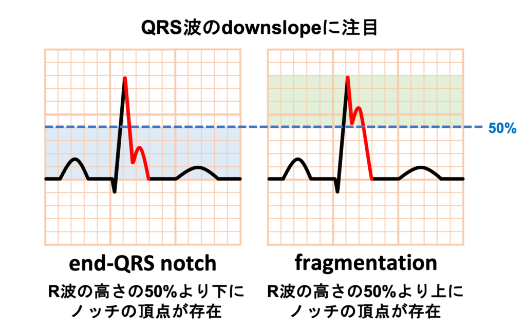早期再分極(early repolarization)