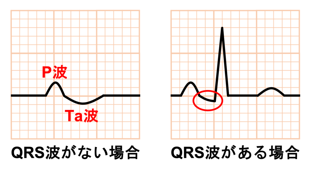 Ta波(Ta wave)