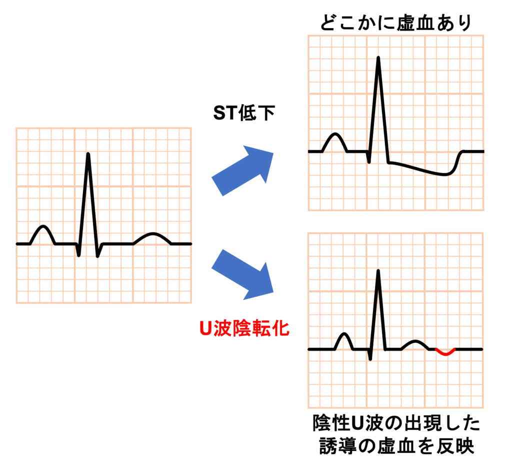 陰性U波(negative U wave)