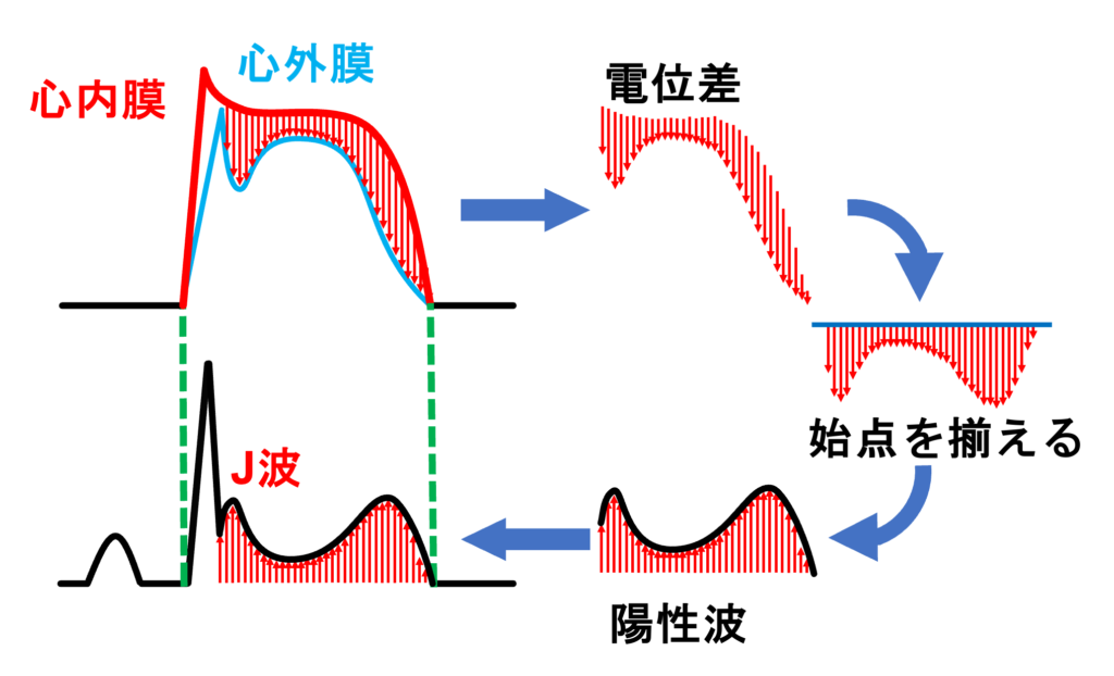 早期再分極症候群(early repolarization syndrome)