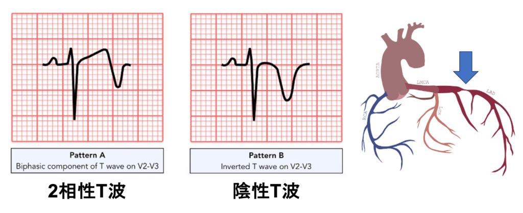Wellens症候群(Wellens syndrome)