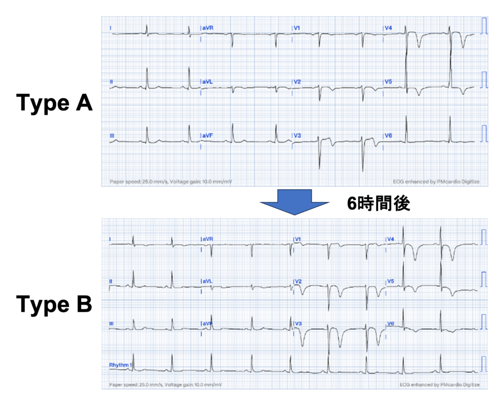 Wellens症候群(Wellens syndrome)