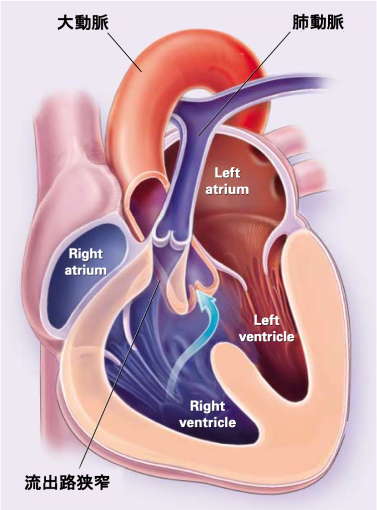 Tetralogy of Fallot