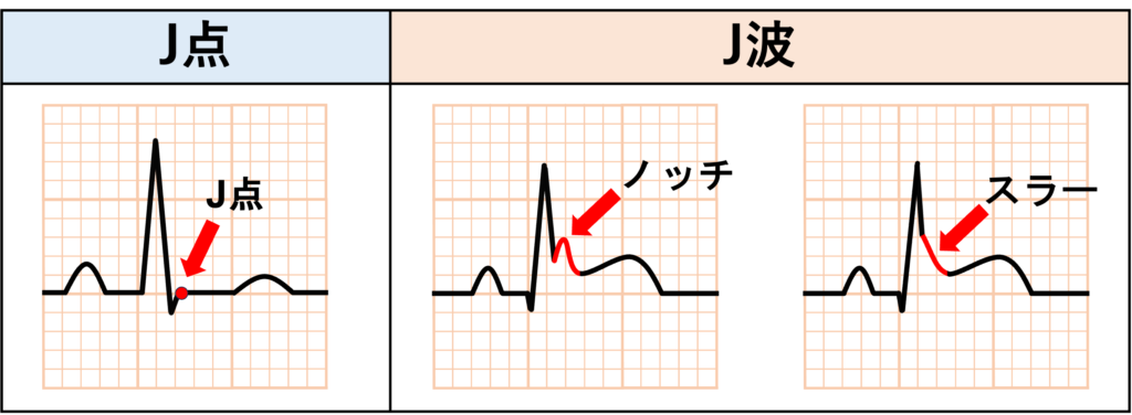 J波。J点と似ている言葉としてJ波があります。J波はJ点そのものではなく、J点付近に形成される波形です。ノッチ・スラーまたはドーム状の陽性波であり、低体温で有名なOsborn波もJ波です。他にも早期再分極、高カルシウム血症、Brugada症候群などで見られます。