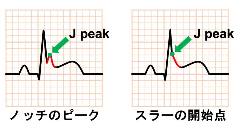J点(J point)
J波がある場合のJ点の扱いに関しては、明らかなノッチがある場合はノッチの頂点をJ点、スラーがある場合はスラーの開始点やピークをJ点とする考え方があります。近年の早期再分極に関連する定義では、ノッチのピークやスラーの開始点をJp(J peak)として扱うことが多いです。