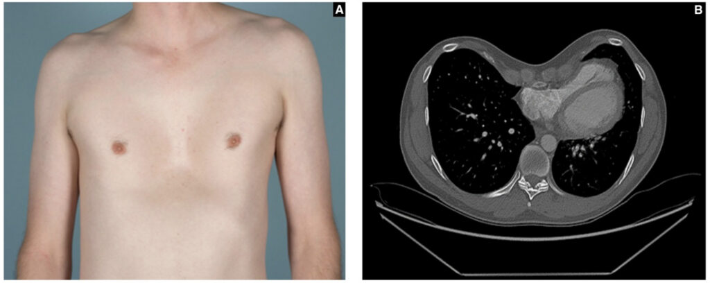 漏斗胸(pectus excavatum)