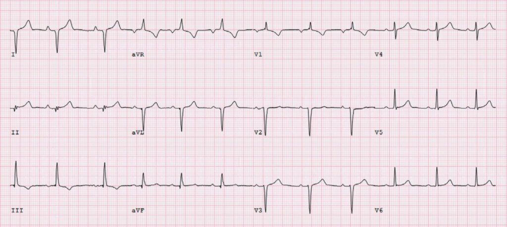 漏斗胸(pectus excavatum)