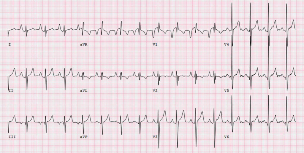 漏斗胸(pectus excavatum)