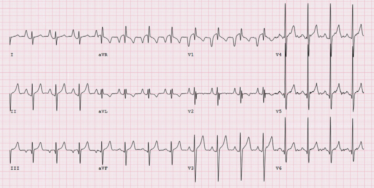 漏斗胸(pectus excavatum)