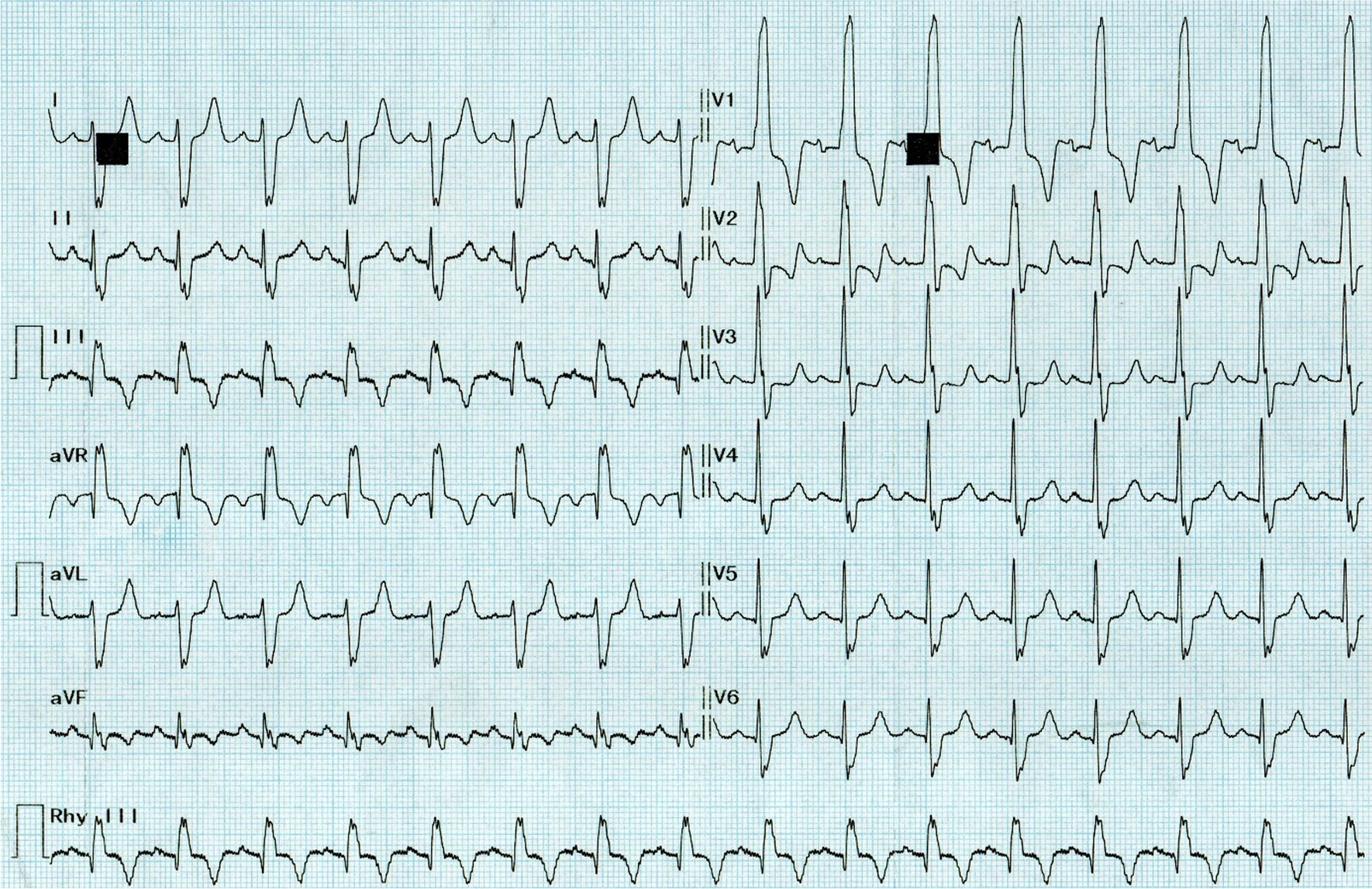 ファロー四徴症(Tetralogy of Fallot：TOF)