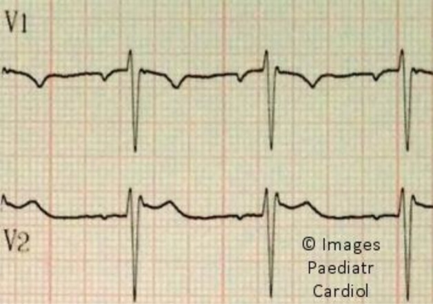 漏斗胸(pectus excavatum)