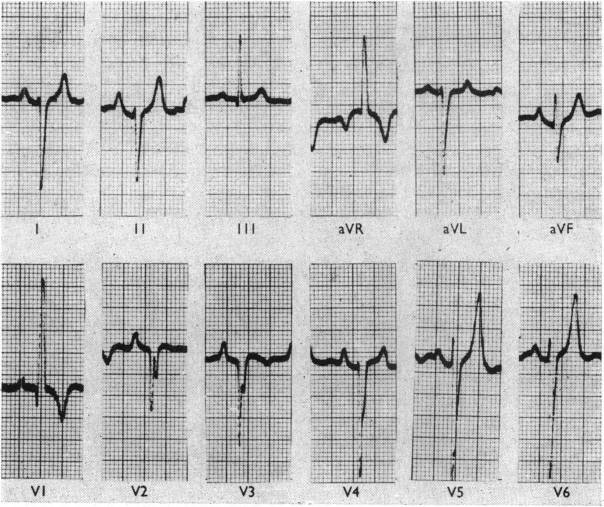 完全大血管転位(complete transposition of great arteries)
