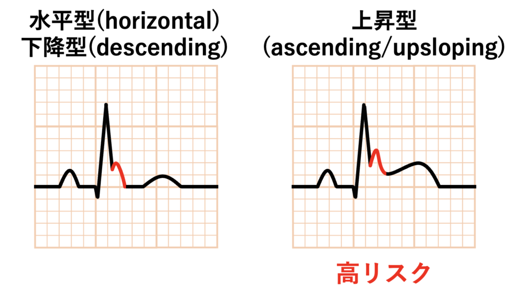 早期再分極症候群(early repolarization syndrome)