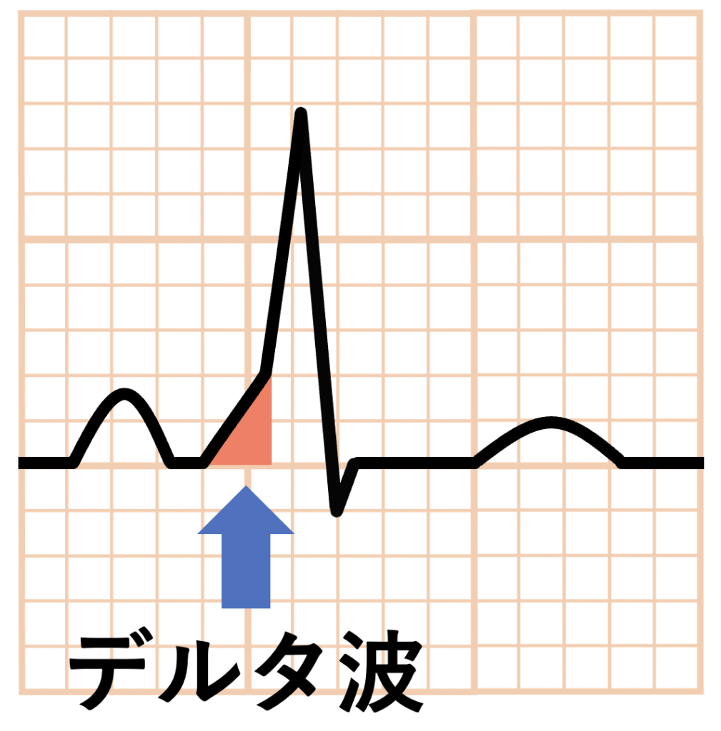 Δ波(delta wave)