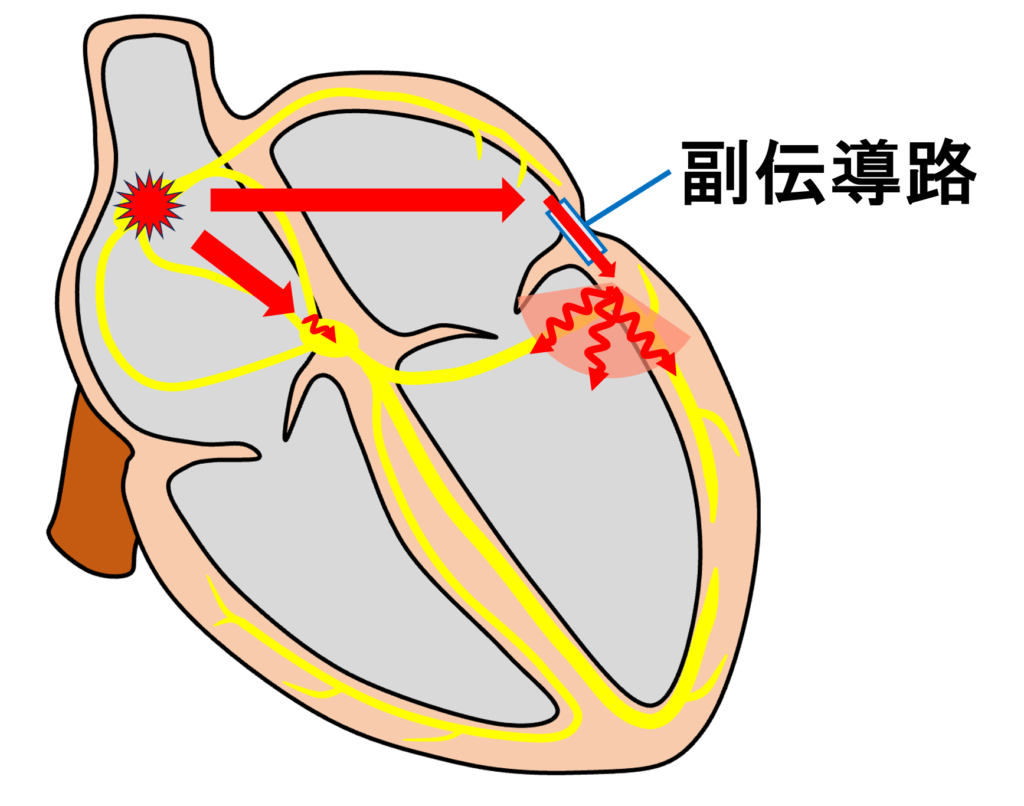 Δ波(delta wave)