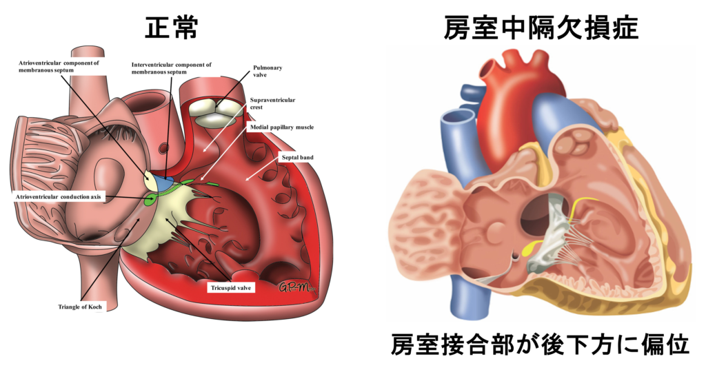 房室中隔欠損症(atrioventricular septal defect)