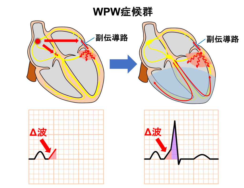 Δ波(delta wave)